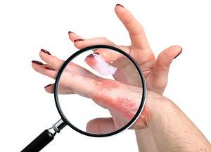 sedef hastalığı kremleri