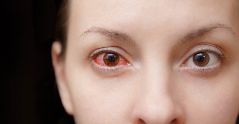 göz kanlanması neden olur