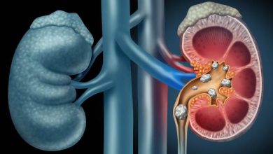 Böbrek taşı nelerden oluşur