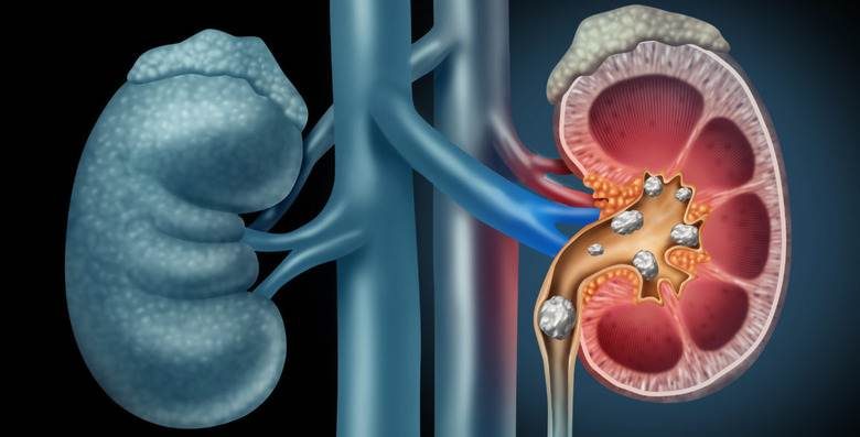 Böbrek taşı nelerden oluşur