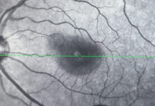 Optik Nevrit