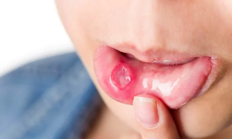 Ağız Kanseri nedir?