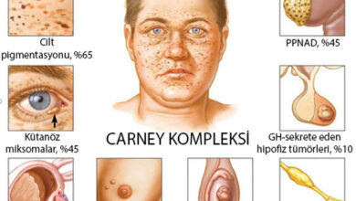 Carney kompleksi nedir