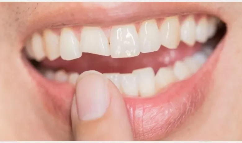 Diş Kırılması Önlenebilir Mi?