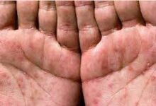 Frengi (Sifilis) Nedir?