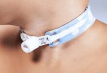 Trakeostomi Nedir?