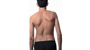 Skolyoz (Omurga Eğriliği) Nedir?