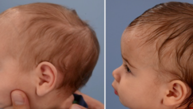 Kafatası Şekil Bozuklukları