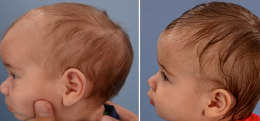 Kafatası Şekil Bozuklukları