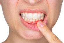 Periodontitis Tedavisi