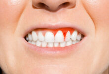 Gingivitis