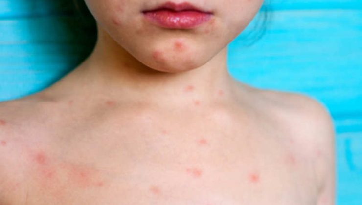 Su çiçeği nedir? Belirti ve tedavi yöntemleri nelerdir?