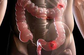 Üretra kanseri nedir? Belirtileri ve tedavisi